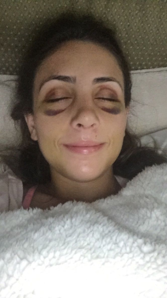 bruising under eyes one week after a rhinoplasty