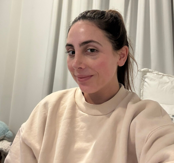 a woman 1.5 weeks after a revision rhinoplasty procedure